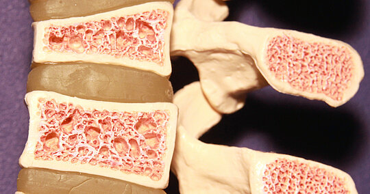 Knochenmodell mit Osteoporose