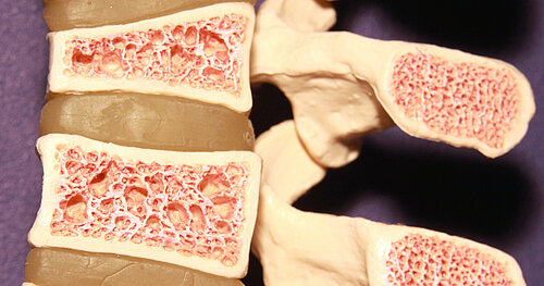 Knochenmodell mit Osteoporose